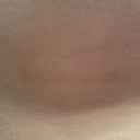 post-op day 45, picture taken of the actual scar, no mirror used