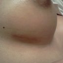 post-op day 45, scar, no mirror. the shadow you see is not discoloration or bruise but the mark of the scaraway strip i just pulled out from the incision site, it's some kind of silicone adhesive stuff so it leaves a bit of a mark.