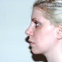 1 year 2 months post-op.  Roughly 4 weeks since in-office procedure.

There is still tip swelling.