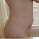 2 1/2 wk PO- different, but not better yet.  Lots of swelling. oh and numbness above incision