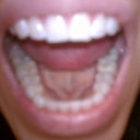 Finished my treatment. I'm trying to get clearer pictures.