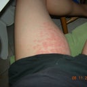 Yesterday.  Today, both legs have red welts.