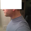 5 days after surgery