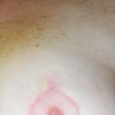 Left areola