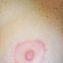 Right areola