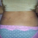 1 month post op ... Extended scar