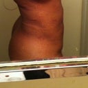 2nd day after procedure