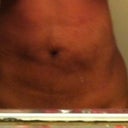 2nd day after procedure