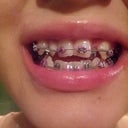 Day 1 with braces