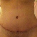 Day 6 post op. Very swollen but healing well.
