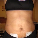 Day 1 post op