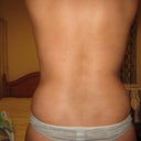 This is 4 weeks post-op
