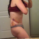 Day 9 post op