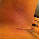 Scar under my arms where I had the extra breast tissue removed. Looking much better
