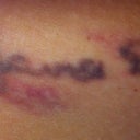 Day 1 After treatment. some bruising.