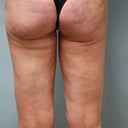 about 4 months post cellulaze and lipo.