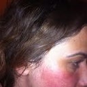 very close day 3 second treatment