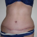 My scar at 3 months ~
