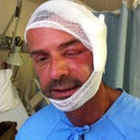 after surgery