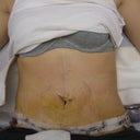5 days post op at the PS office