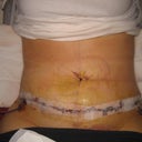 5 days post op.  Later that evening, more swelling but I really love the results.