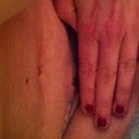 Do you see what I see? Hello  friend long time no see day 8 note the difference of mole in previous photo