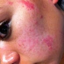 My cheek today.