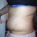 This is my left side at POD 19.  This side is really swollen, but there is not a seroma there at this time.   It just looks weird!