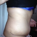 This is my right side at POD 19.  I am a lot more happy with the shape fo this side of my body at this point, but there is still a huge amount of swelling.