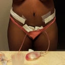 2 days post-op. Dr. used some type of glue to hold me together. All the stretchmarks arent gone though.