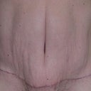 8 wk postop