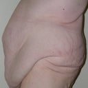 pre-op