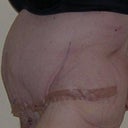 6 days postop- looking a little PG -LOL