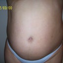 The day before surgery