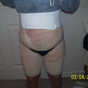 A few hours after surgery
