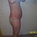 1 day after surgery