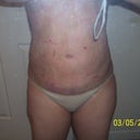 1 day after surgery