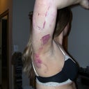 2 days after arm surgery