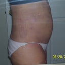 3 months after surgery