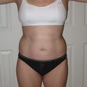 After-front at about 1 month