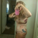 3 days post op! Lots os swelling area bra band but no where else