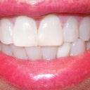 My teeth before Invisalign.  Using a bottom tooth veneer to give the illusion of straighter teeth.  Others on lower R also misaligned. Slight bunching of front teeth over side ones.