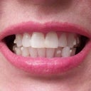 Removal of lower veneer. Shaved teeth to accelerate movement with Invisalign. Now they look uneven. This made them slightly more unsightly. Unexpected aligner buttons!