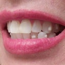 Very visible aligner buttons all over my teeth! Changing the color would not help. They need clear composite.