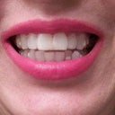Invisalign trays on.  White composite filling was added to Invisalign tray were missing teeth are, until I get the implants.