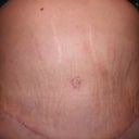 front view of my new tummy