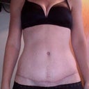 Pic of scar. Nice and flat. Still a little red
