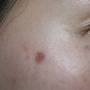 Burn from age spot treatment