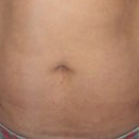 my hysterectomy scars...1 on left,1 on right,1 down my belly button...all above my c-section scar & above my undies...tummy tuck should get rid of these.