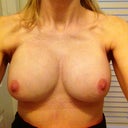 1 week post surgery- revision with Capsullhaphory